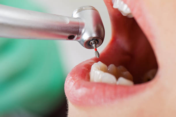Best Emergency Root Canal Treatment in Bessemer City, NC